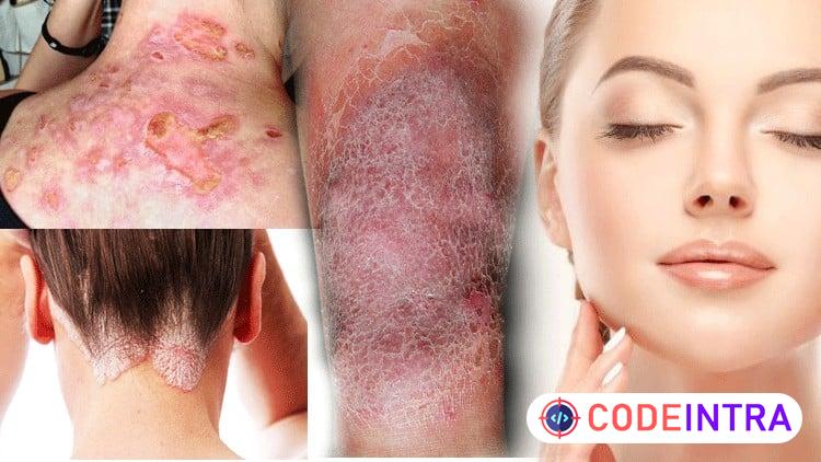 Certificate In Skin Disorders Alternative Therapy Treatment preview